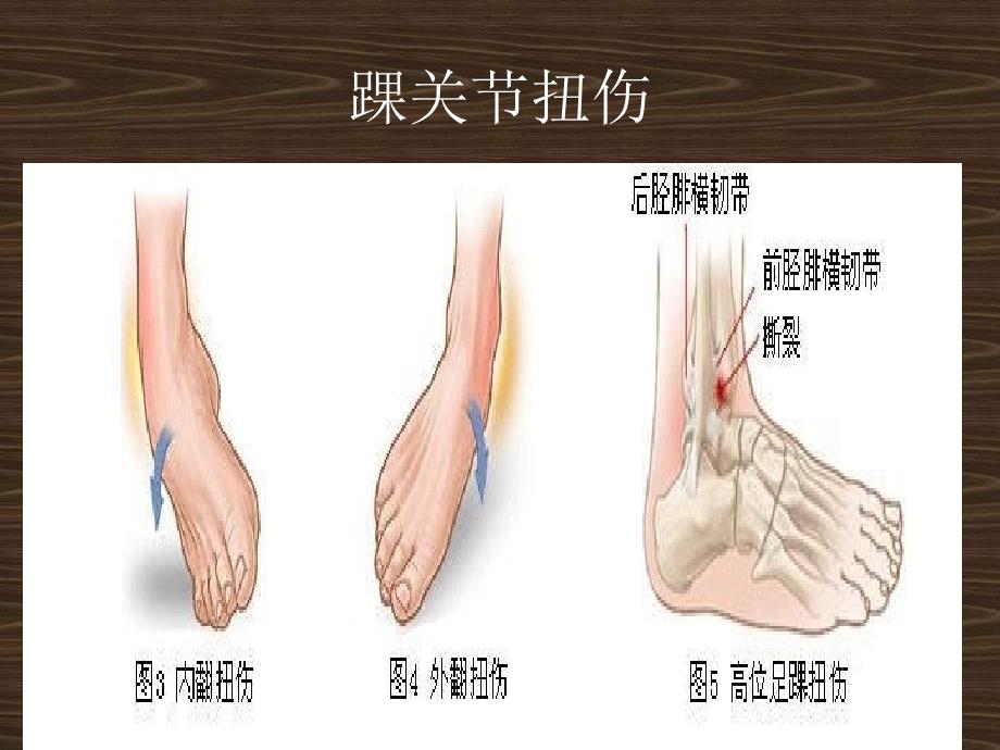 踝关节扭伤超声药物导入消炎镇痛治疗_第4页