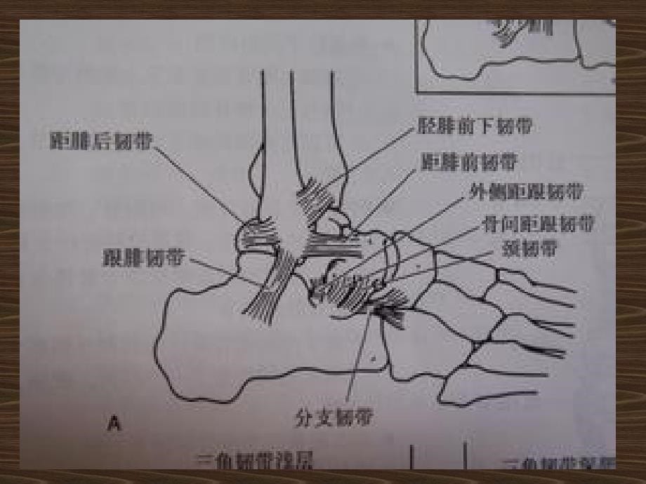 踝关节扭伤超声药物导入消炎镇痛治疗_第5页