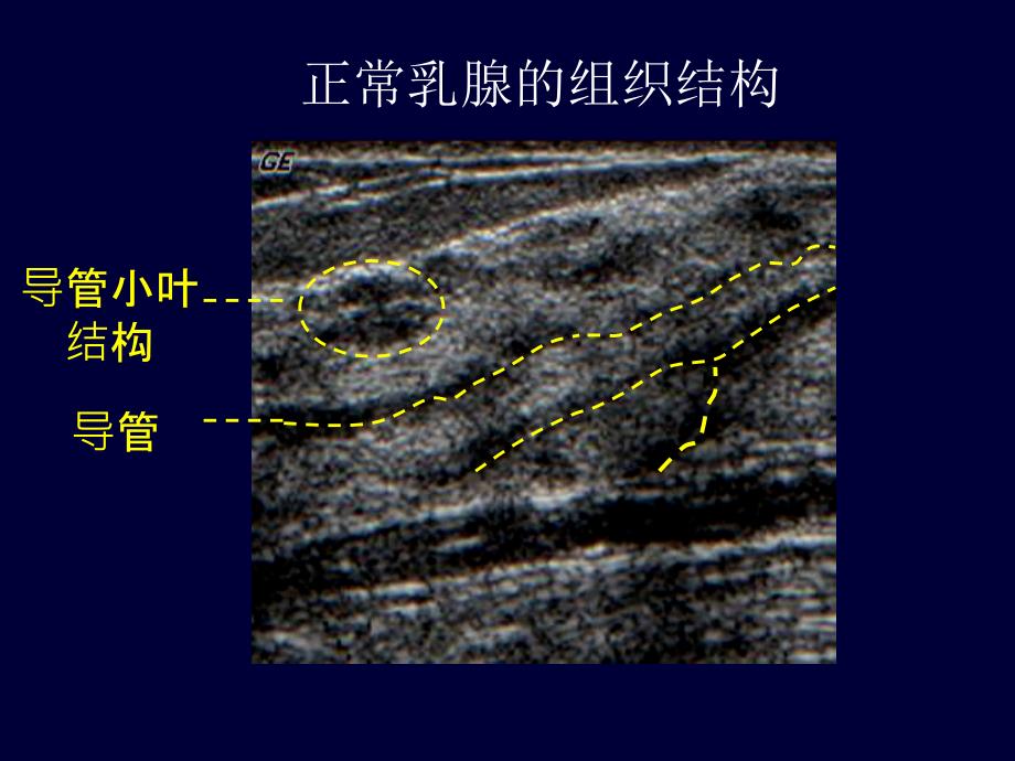 乳腺超声培训课件_第4页