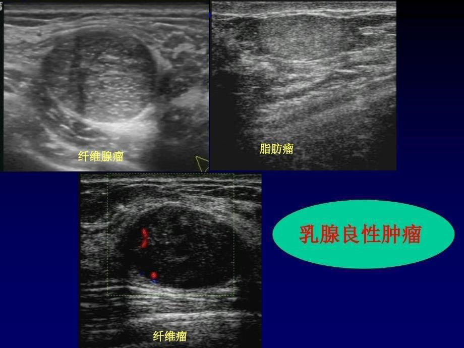 乳腺超声培训课件_第5页