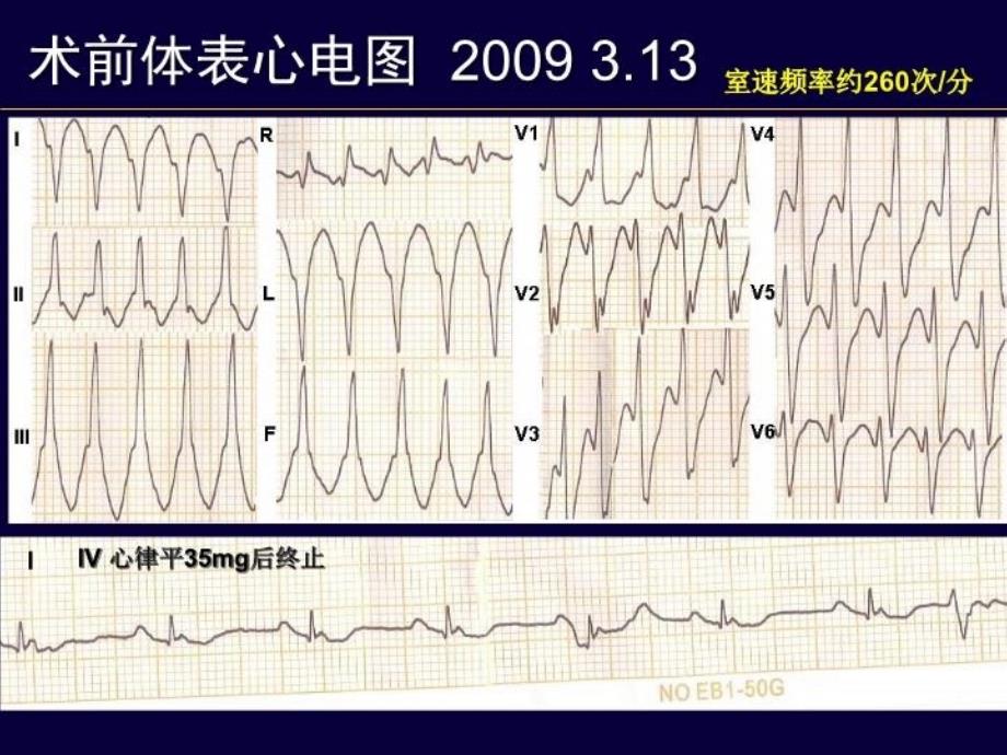 最新左室室心动过速消融一例PPT课件_第3页