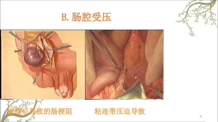 肠梗阻教学课件_第4页