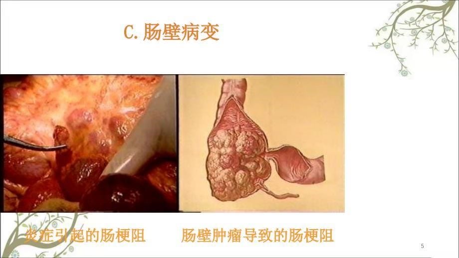 肠梗阻教学课件_第5页