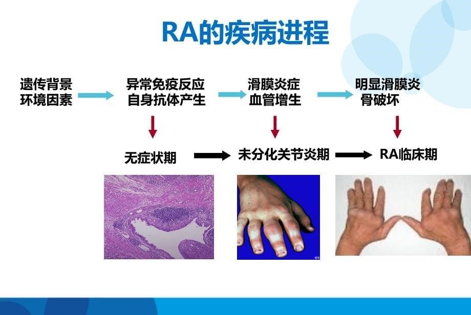 类风湿的规范诊治_第5页