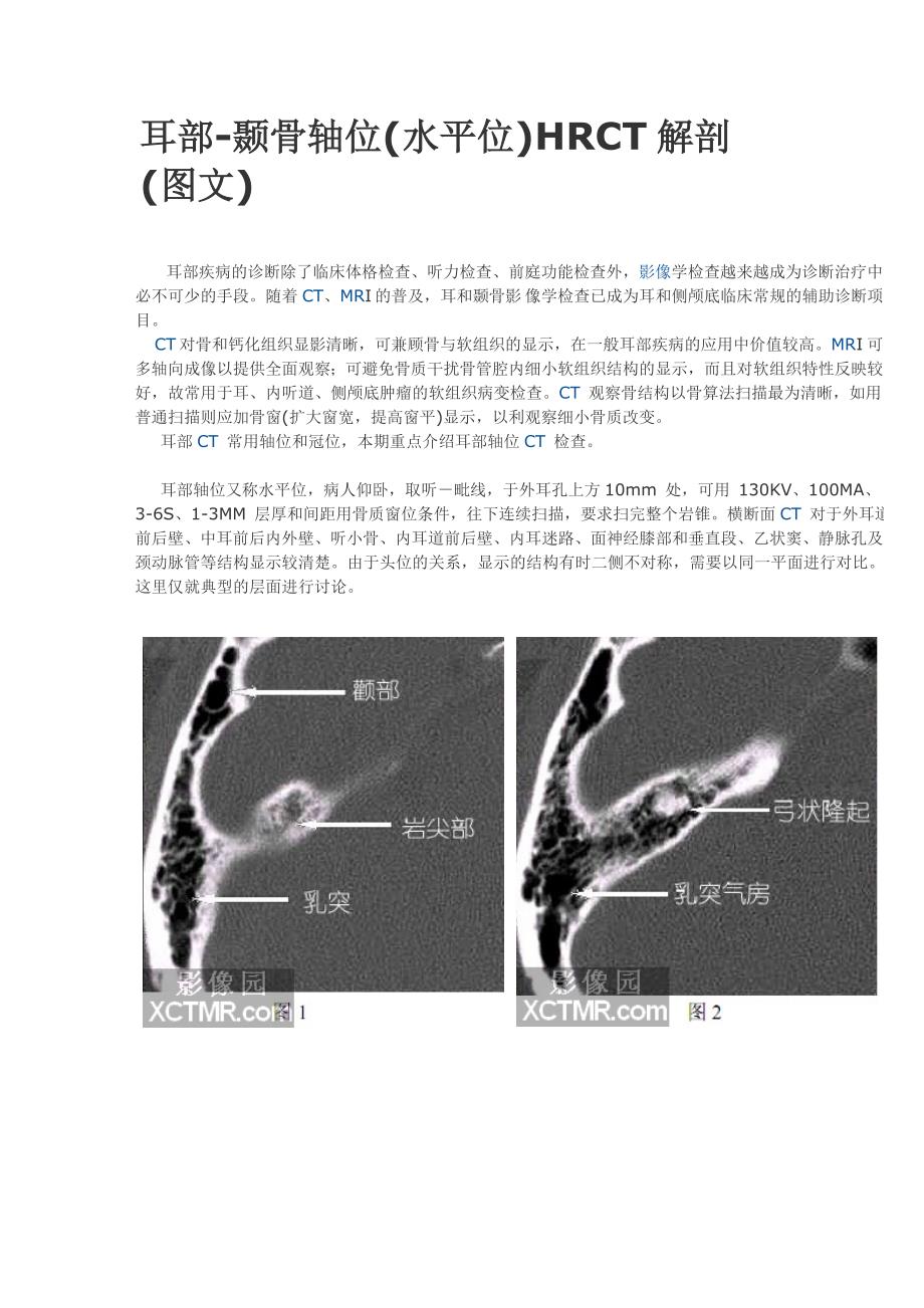 耳部-颞骨轴位(水平位)HRCT解剖.doc_第1页