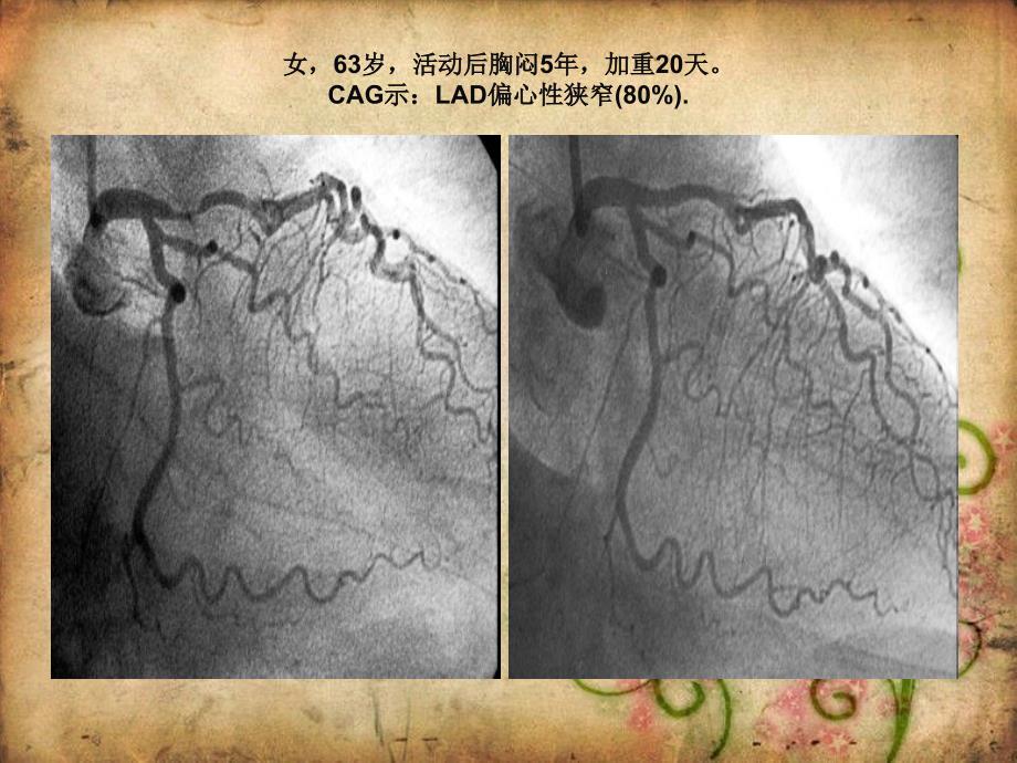 课件：中药防治冠心病.ppt_第1页