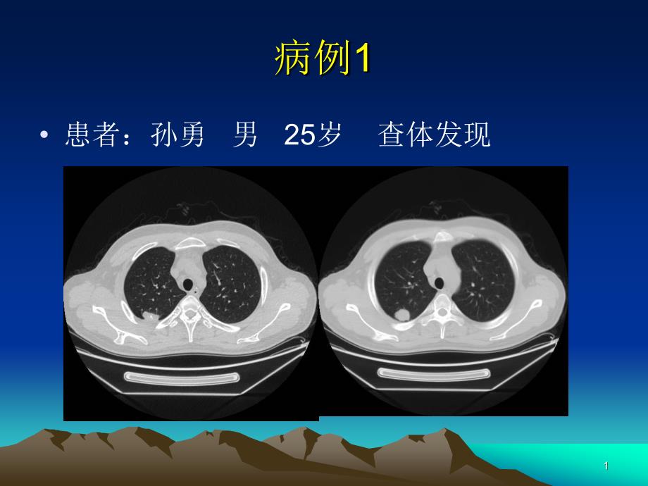 医学ppt肺错构瘤影像表现_第1页