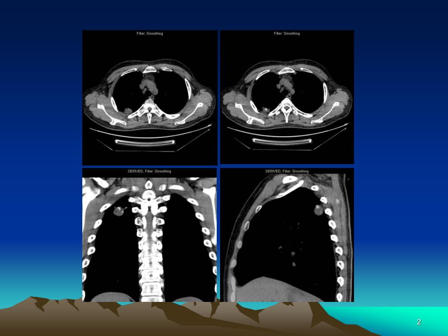 医学ppt肺错构瘤影像表现_第2页