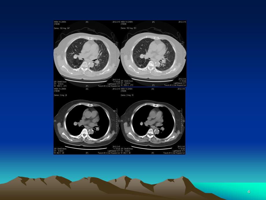 医学ppt肺错构瘤影像表现_第4页