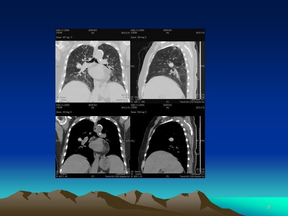 医学ppt肺错构瘤影像表现_第5页