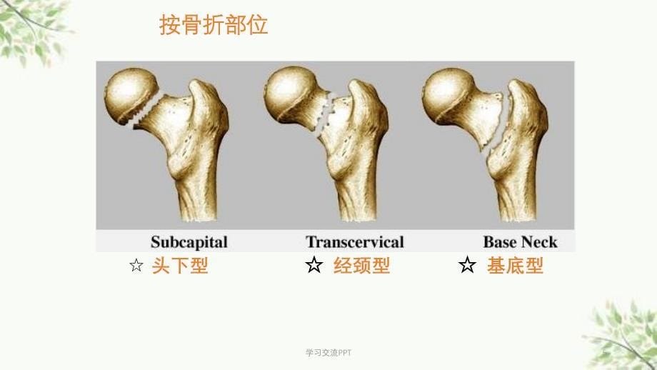 骨科下肢骨折医学课件_第5页