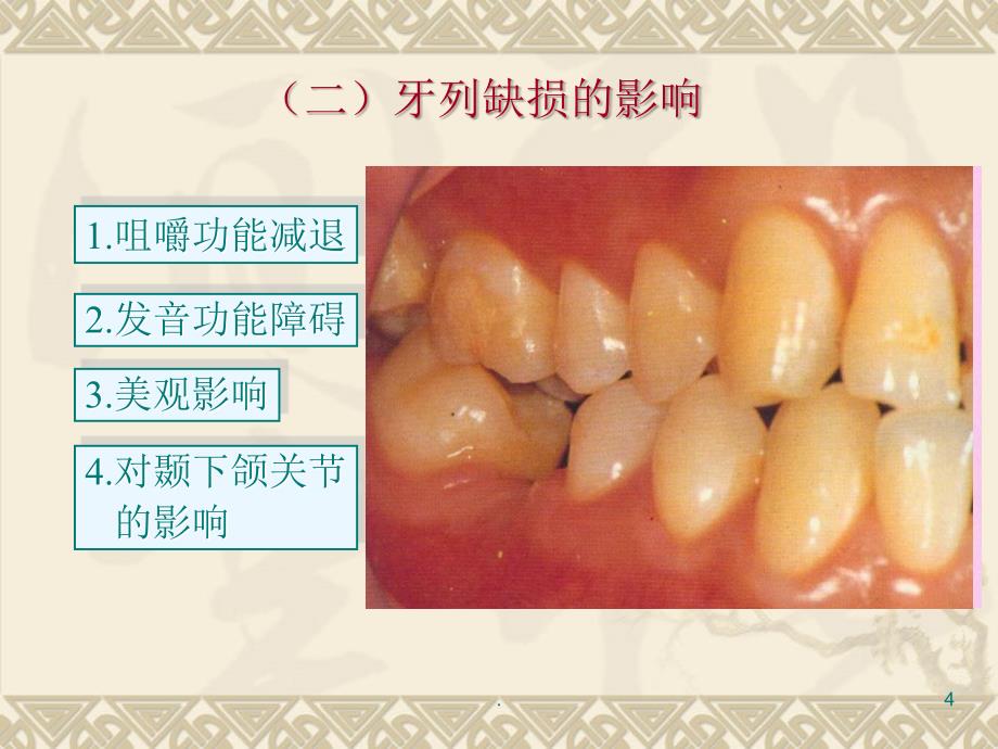 固定桥文档资料_第4页