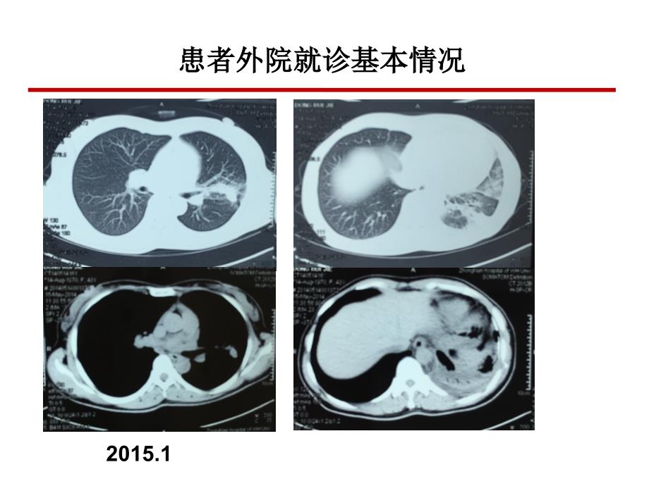 恩度联合放化疗治疗晚期非小细胞肺癌病例分享课件_第3页