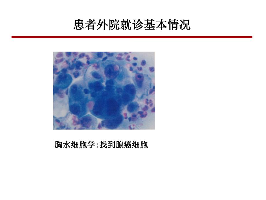 恩度联合放化疗治疗晚期非小细胞肺癌病例分享课件_第4页