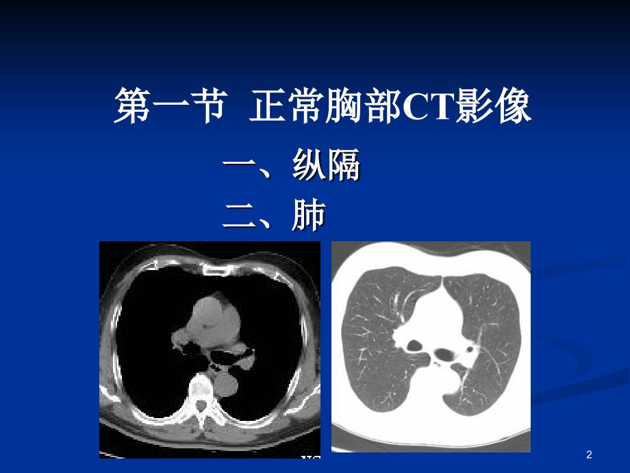 胸部常见疾病CT诊断与鉴别诊断ppt课件_第2页