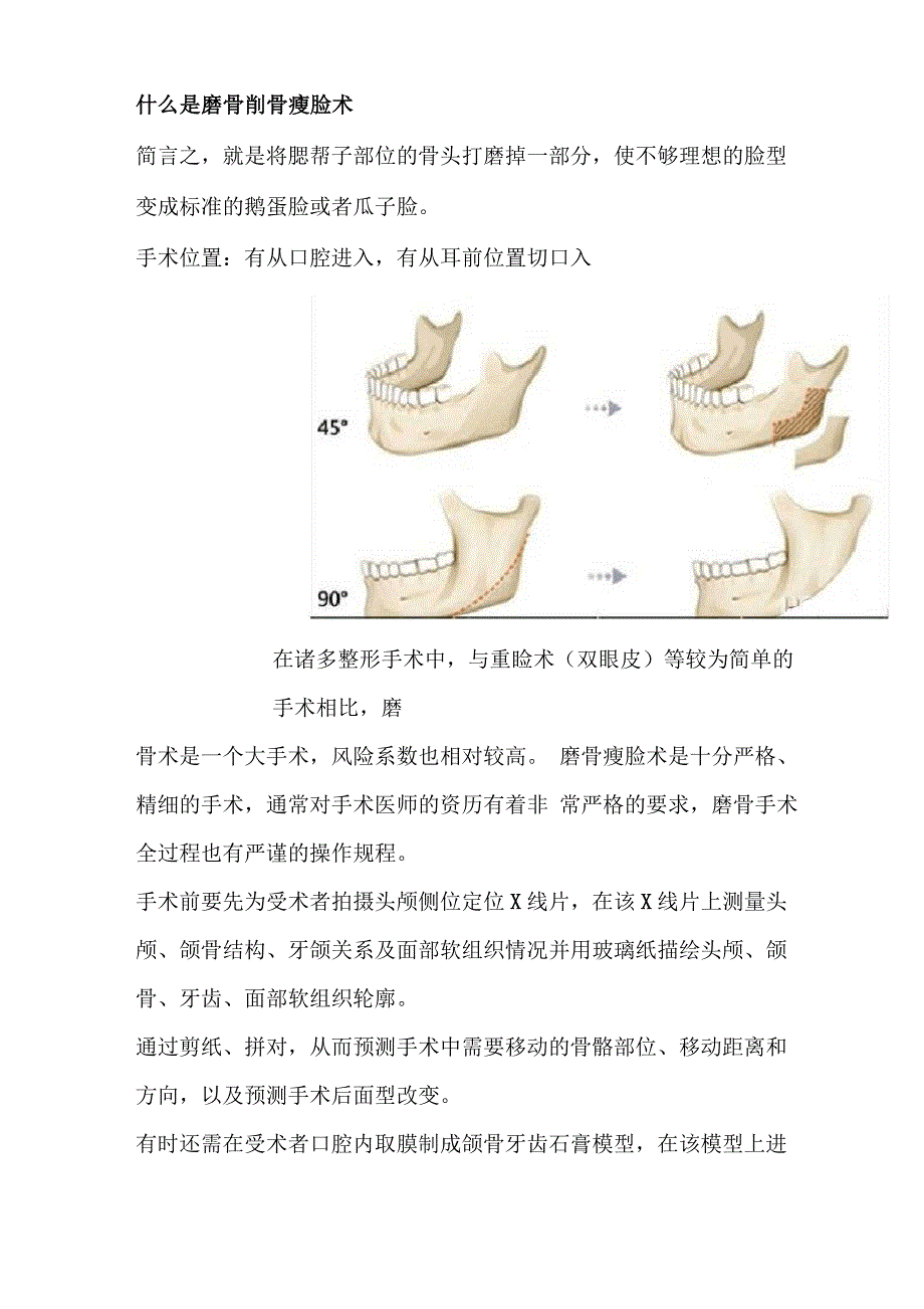 下颌角手术千万别去做削骨5年后骨头又会生长_第4页