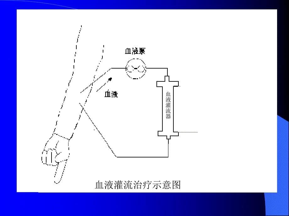 血液灌流的临床应用ppt课件_第5页