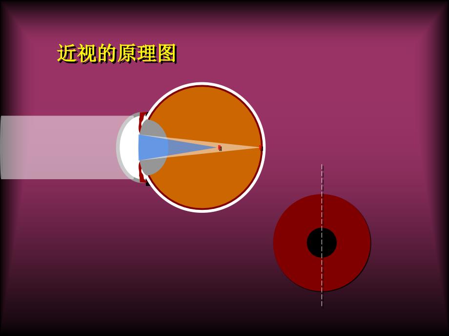 角膜塑形镜原理课件_第3页