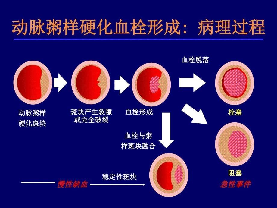 急性脑梗死的溶栓及抗栓治疗_第5页