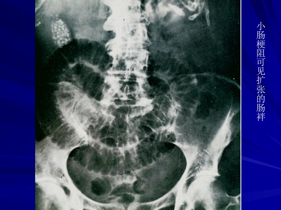 炎性肠梗阻PPT课件_第2页