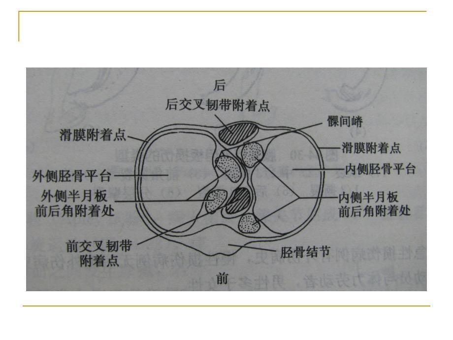 膝关节半月板损伤及护理课件_第5页