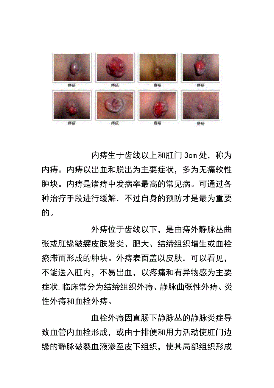 根治痔疮秘方.doc_第2页