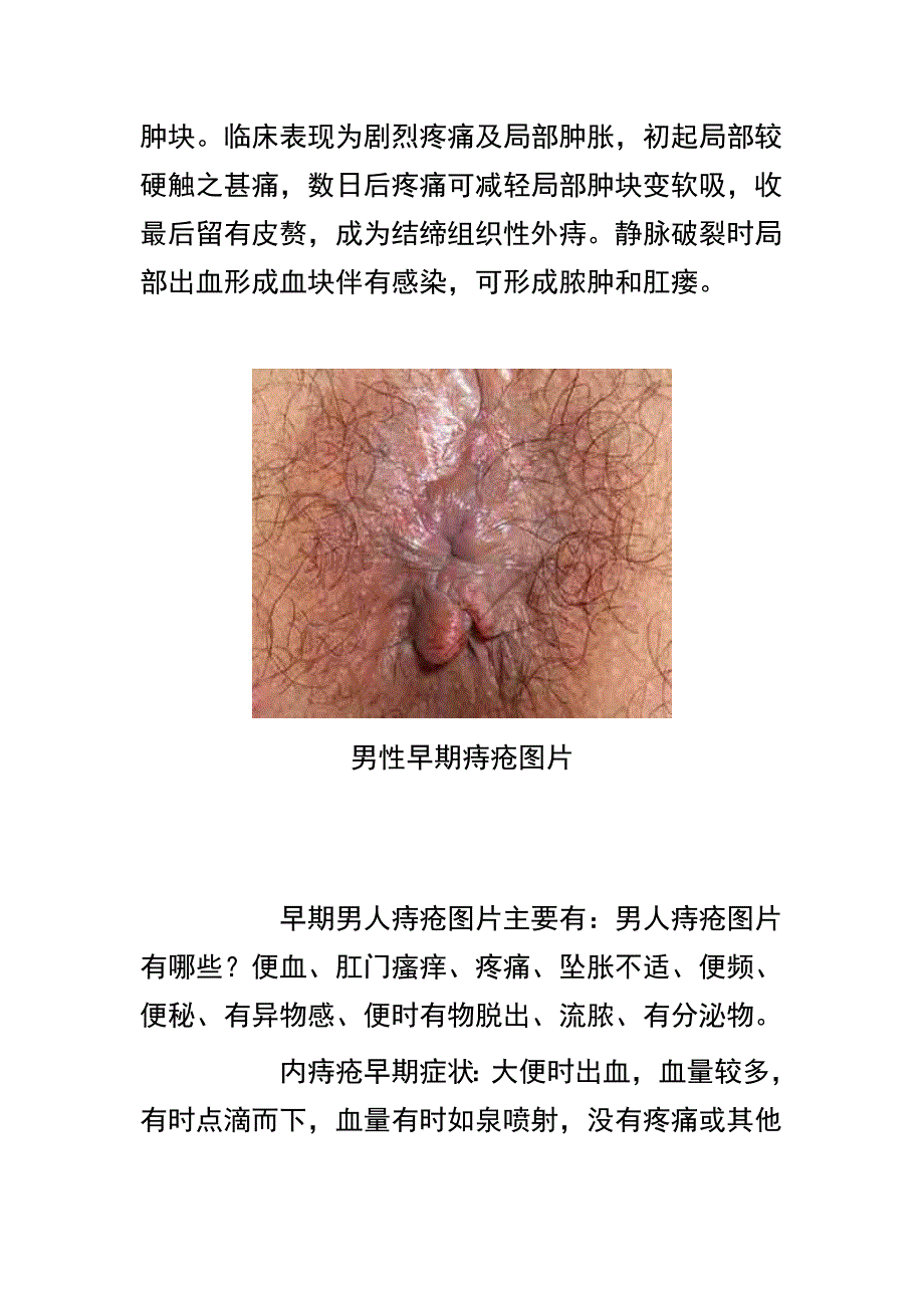 根治痔疮秘方.doc_第3页