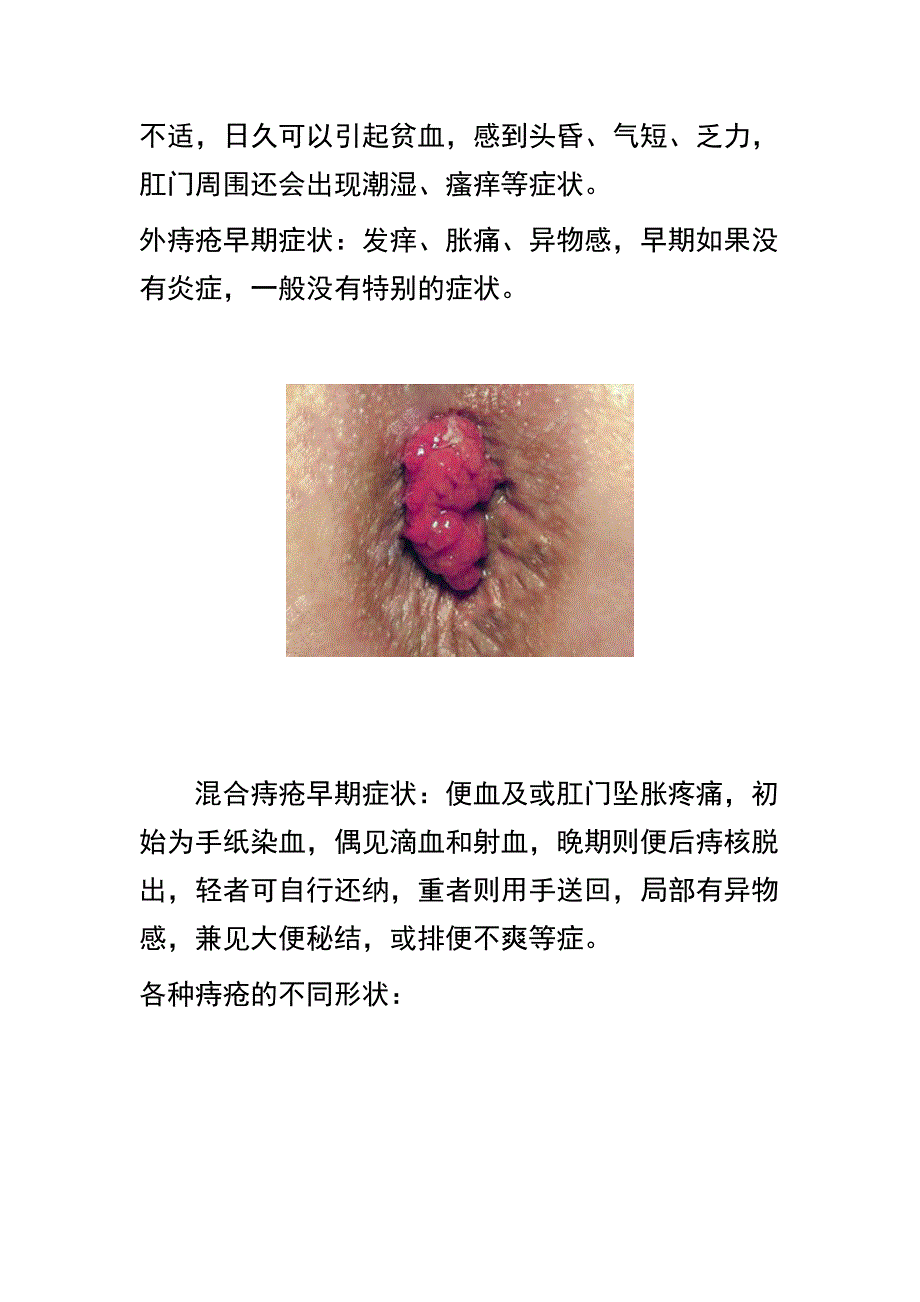 根治痔疮秘方.doc_第4页