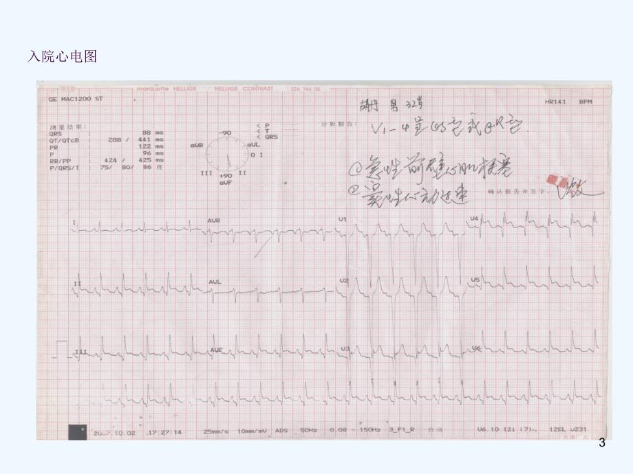 特殊原因急性心肌梗死一例ppt课件_第3页