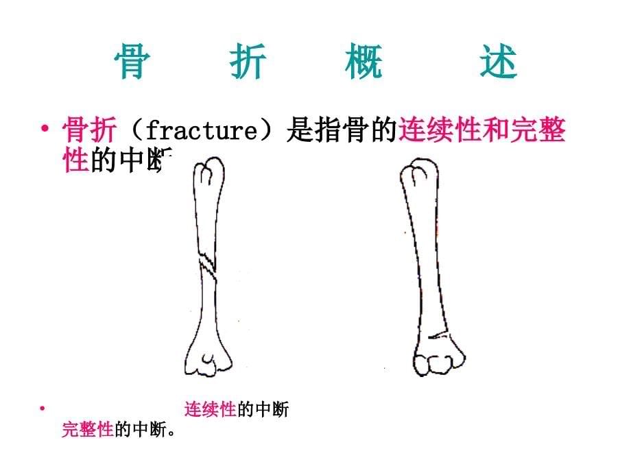 第二十章骨与关节疾病病人的护理_第5页