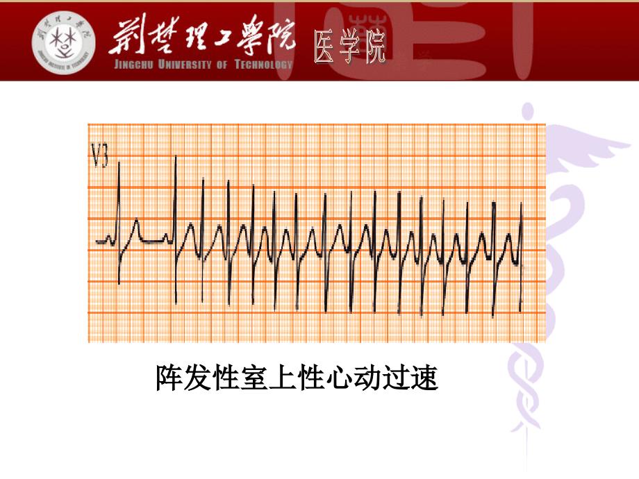 心电图图片课件_第2页