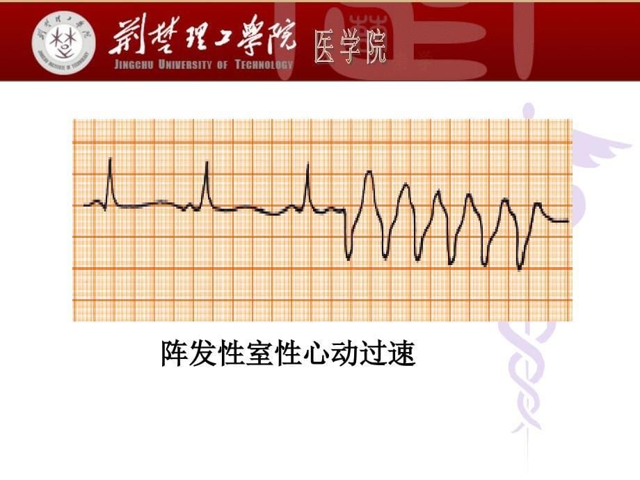 心电图图片课件_第5页