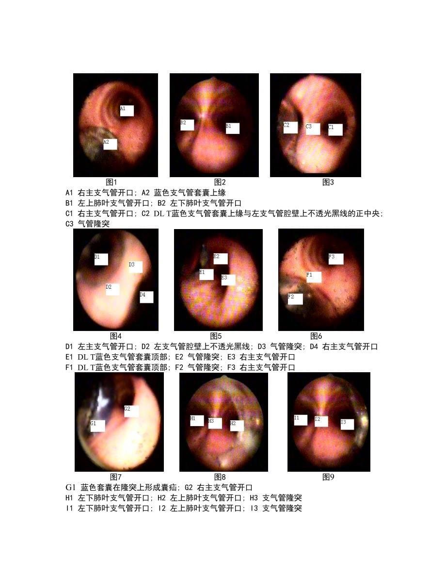 左双腔支气管导管插管深度的研究.doc_第5页