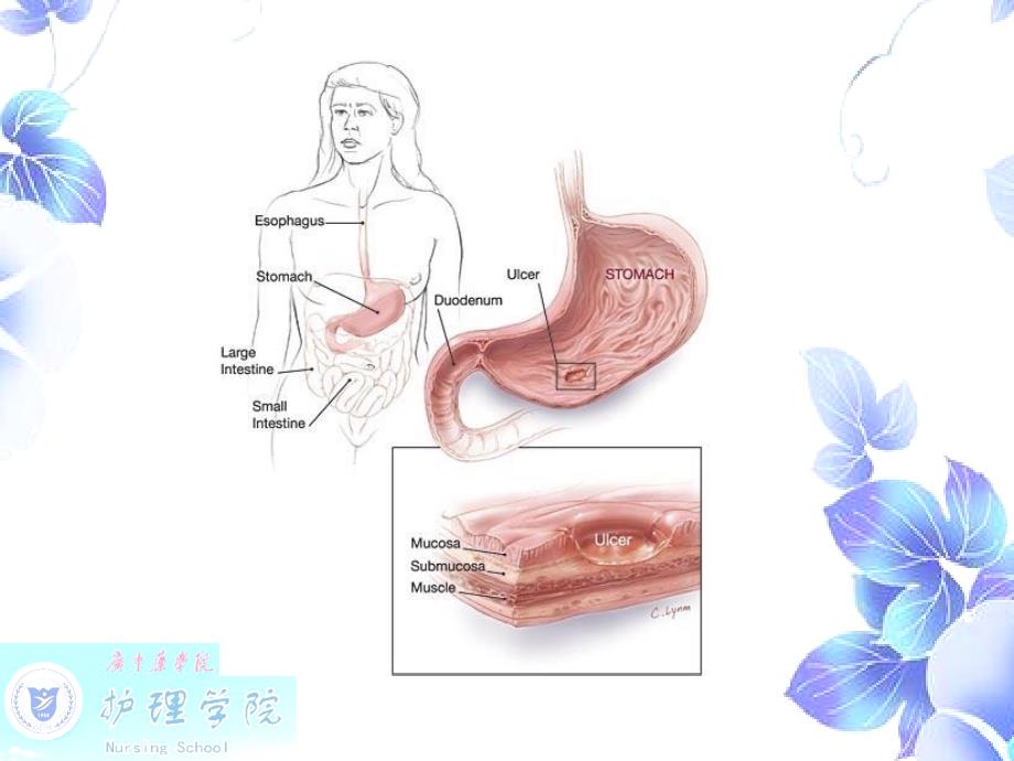 内科护理学消化性溃疡病人的护理PPT文档_第4页