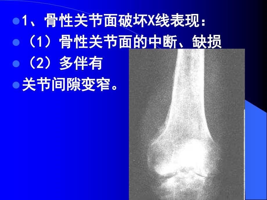 关节病变的基本x线表现_第5页