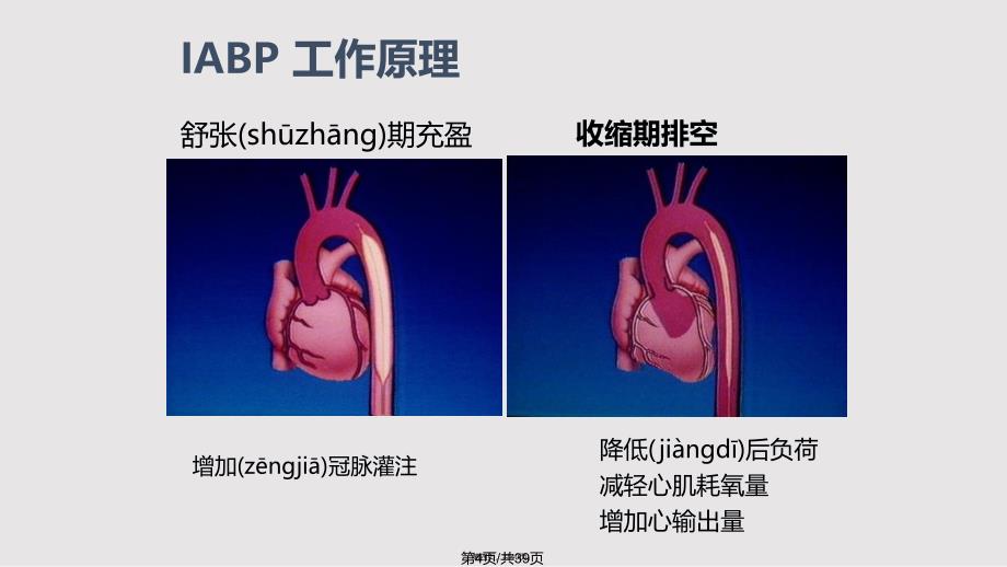 IABP的临床应用实用教案_第3页