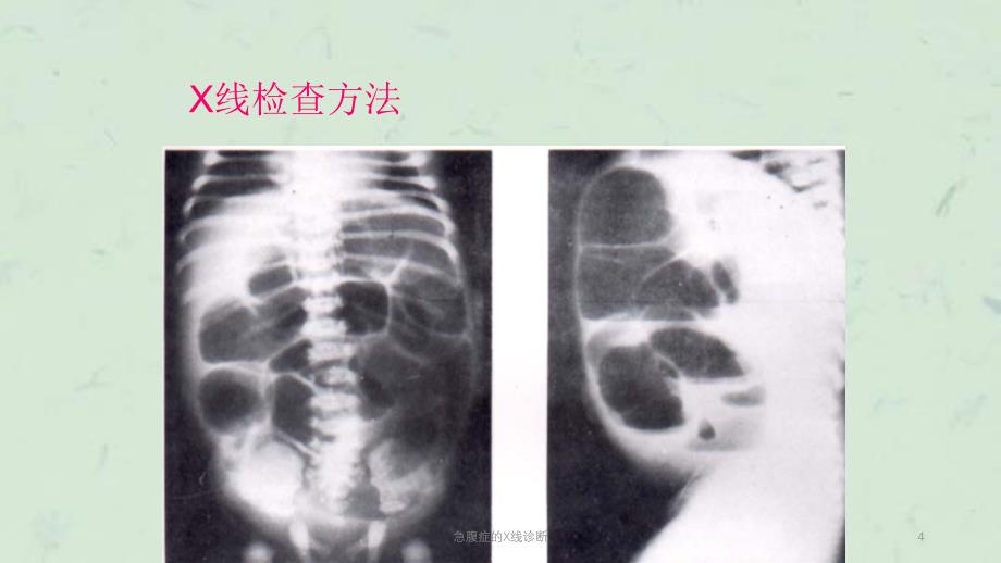 急腹症的X线诊断课件_第4页