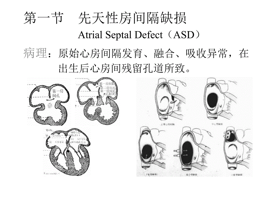 先天性心血管病PPT课件_第3页