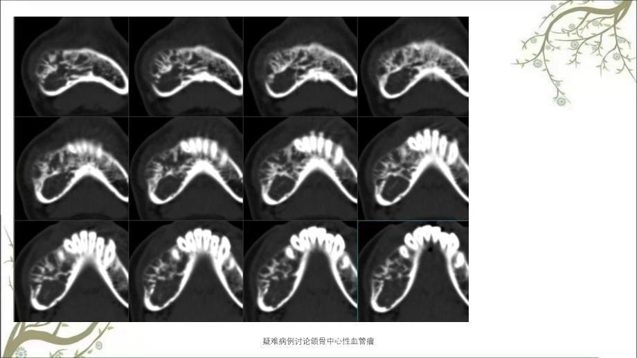 疑难病例讨论颌骨中心性血管瘤课件_第5页