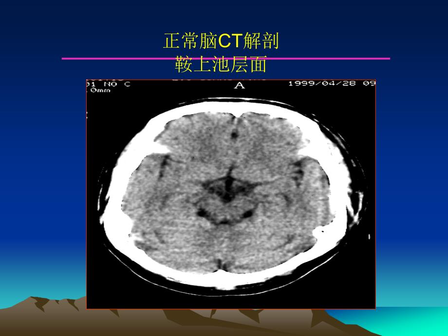 中枢神经系统像诊断学课件_第3页