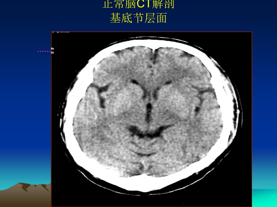 中枢神经系统像诊断学课件_第4页