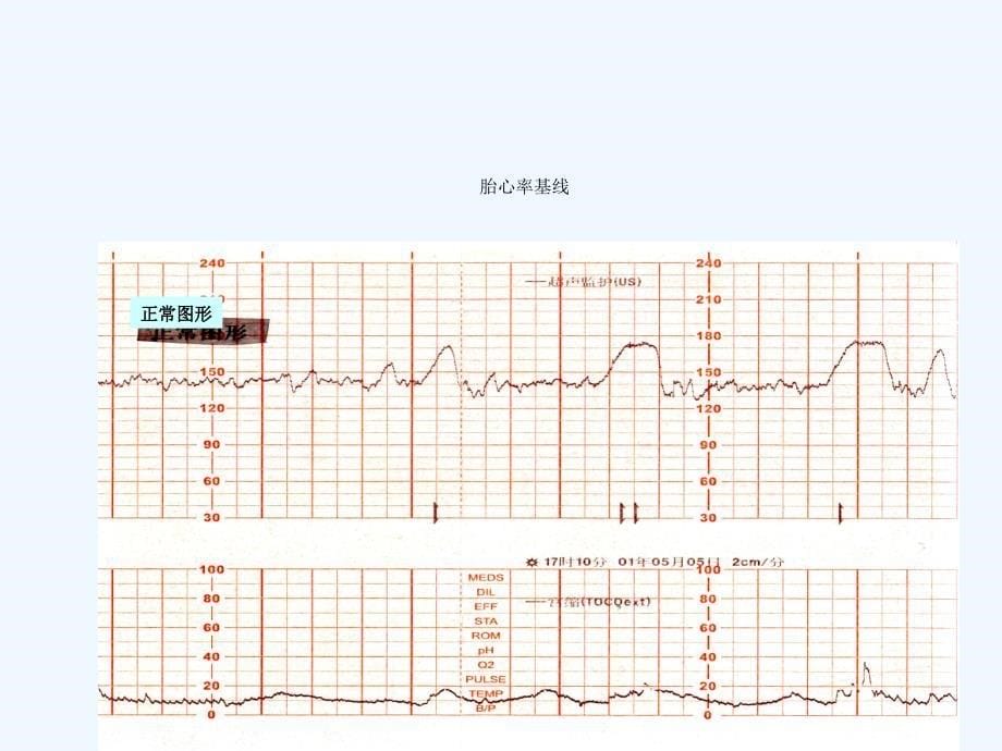 胎心监护基本分析课件_第5页