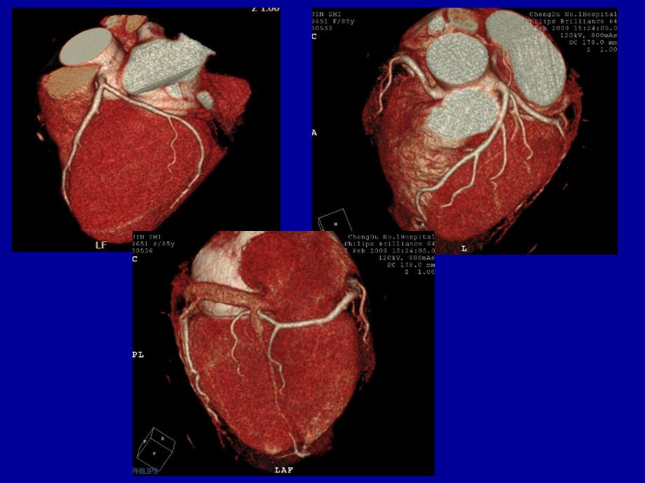 冠状动脉CTA成像_第3页