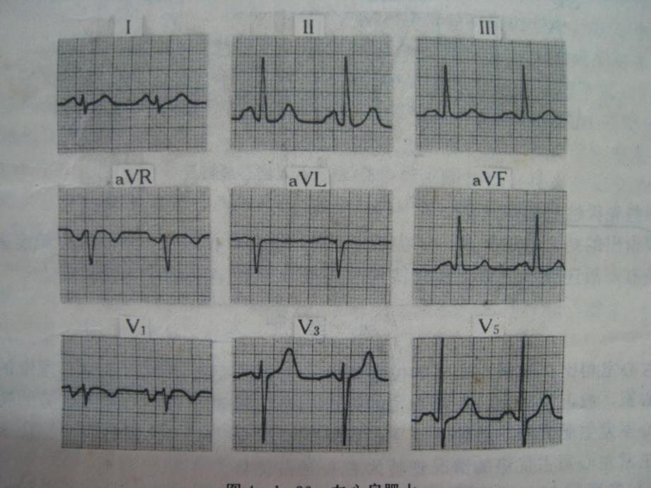 看图识心电PPT课件_第3页