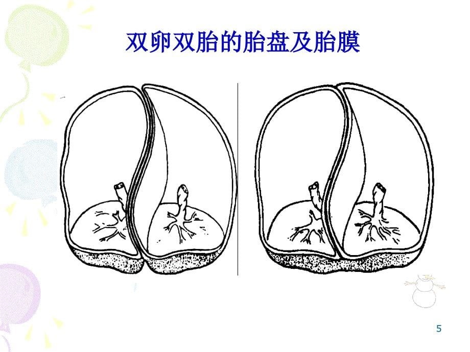 多胎妊娠和巨大胎儿讲义_第5页