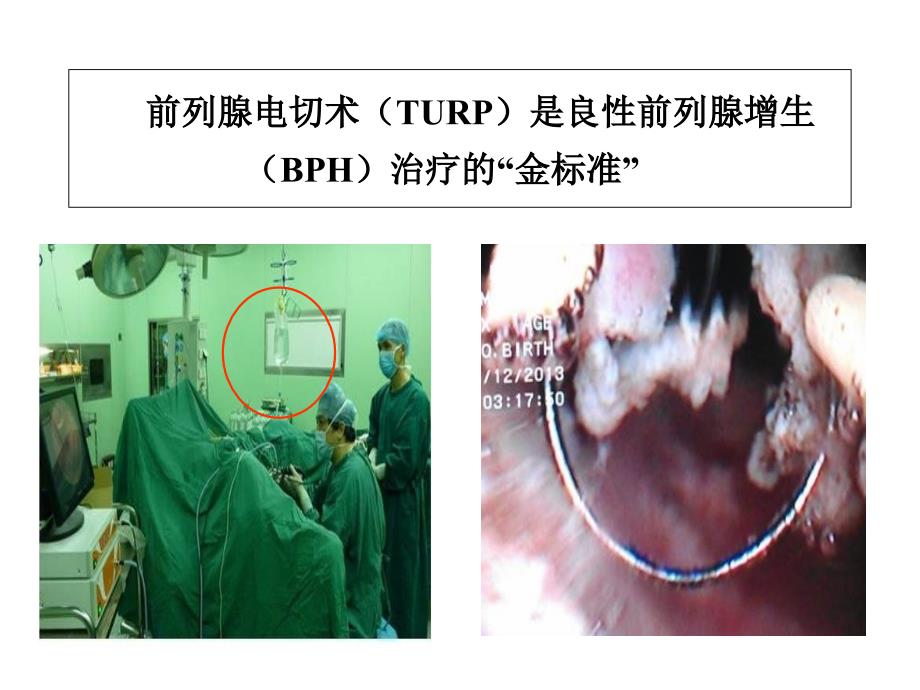 前列腺电切综合征教学提纲_第2页