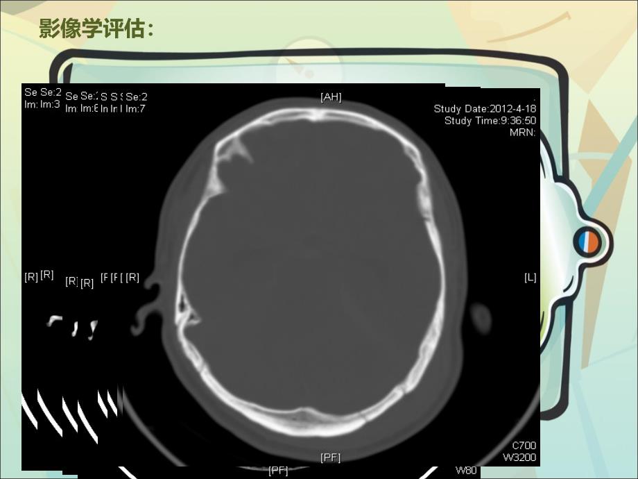 颅内压监测在重型颅脑损伤治疗中的应用PPT课件_第3页