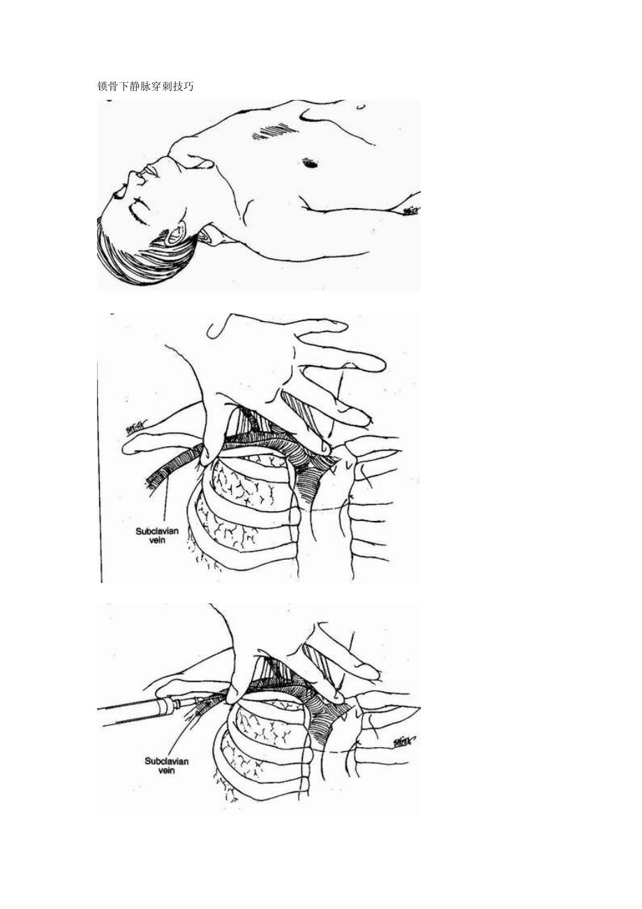 锁骨下静脉穿刺技巧_第1页