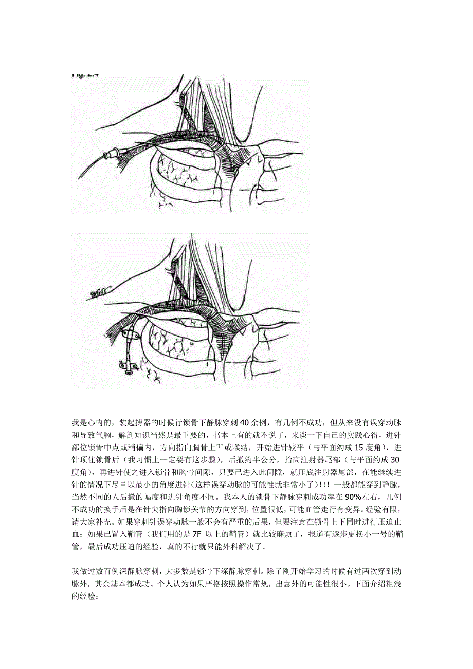 锁骨下静脉穿刺技巧_第2页