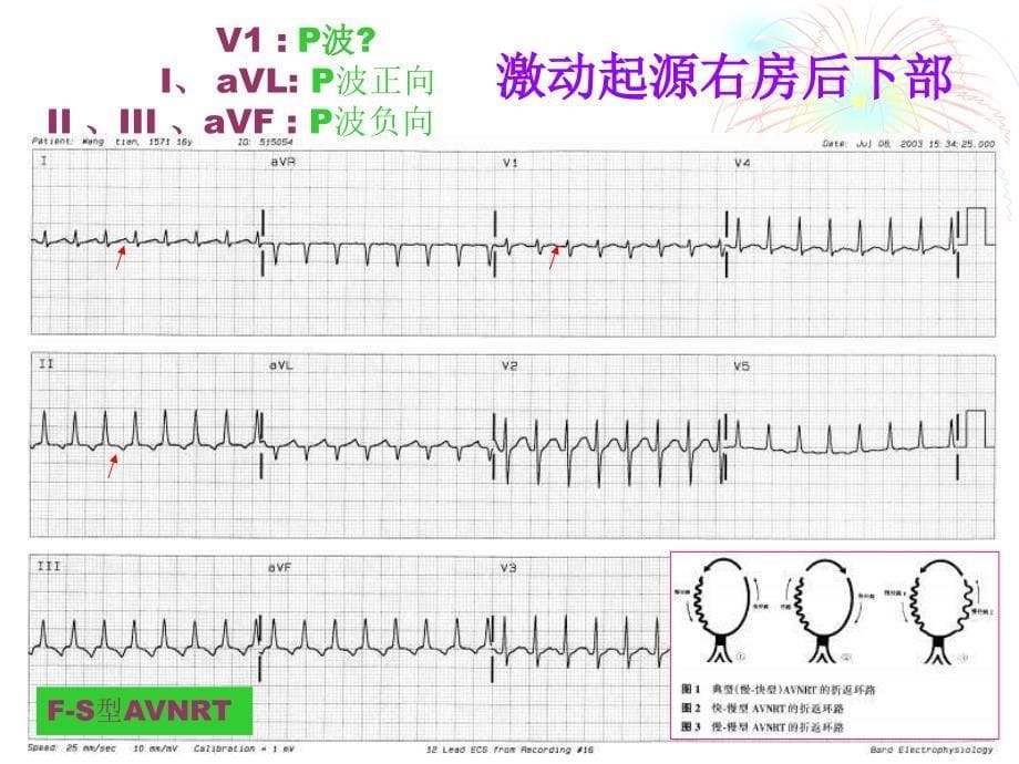 医学课件窄QRS心动过速心电图诊断及鉴别诊断_第5页